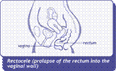 diagram of rectocele