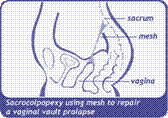 image of sacrocolpopexy